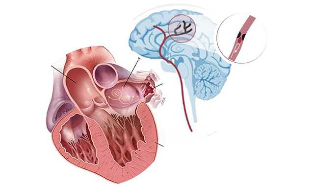 Catheter ablation photo